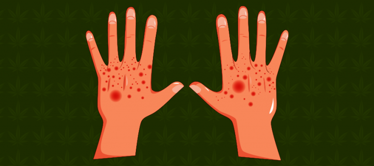 CBD bei Neurodermitis