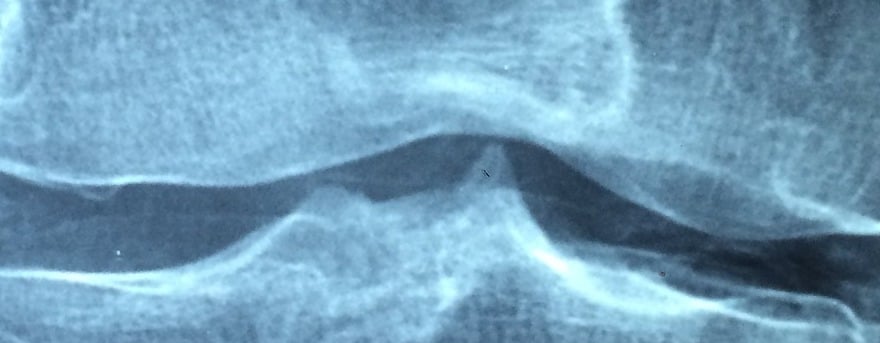 CBD gegen Knochenschwund und Osteoporose