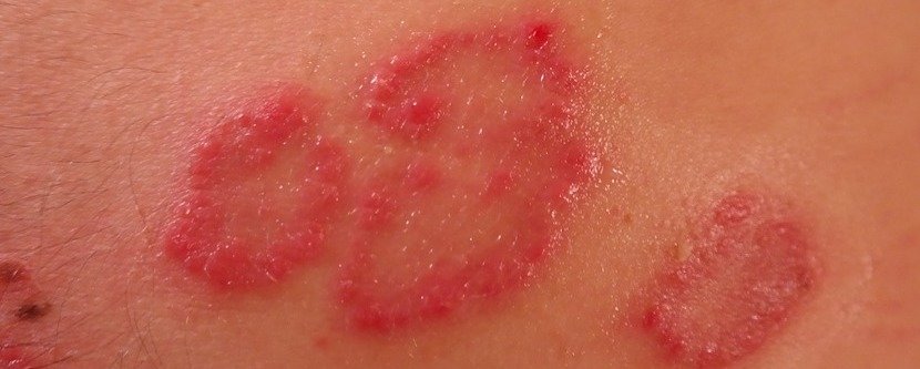 CBD gegen Schuppenflechte